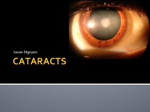 Jason Nguyen CATARACTS What are Cataracts A cataract