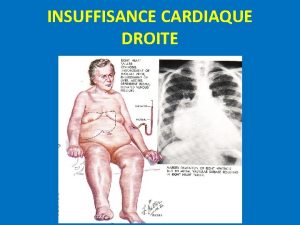 INSUFFISANCE CARDIAQUE DROITE I DFINITION Linsuffisance cardiaque droite