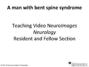 A man with bent spine syndrome Teaching Video