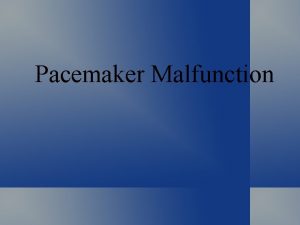 Pacemaker Malfunction ECG Signs of Pacemaker Malfunction Failure