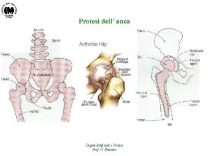 Protesi dell anca Organi Artificiali e Protesi Prof