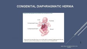 CONGENITAL DIAPHRAGMATIC HERNIA 1 Kathy Wilson RN BSN