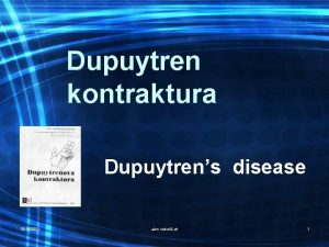 Dupuytren kontraktura Dupuytrens disease 10152021 alen vukeli dr