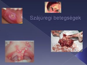 Szjregi betegsgek A fertzses ny s szjgyulladsok Feklyes