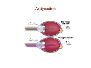 Astigmatism Recognizing the presence of astigmatism When you