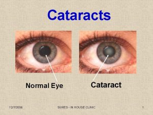 Cataracts Normal Eye 1272006 Cataract SURES IN HOUSE