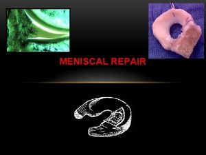 MENISCAL REPAIR Anatomy and Physiology of the Meniscus