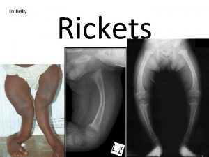 By Reilly Rickets How you get Rickets Rickets