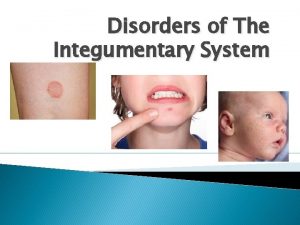 Disorders of The Integumentary System Alopecia Alopecia loss