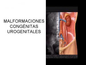 MALFORMACIONES CONGNITAS UROGENITALES MALFORMACIONES RENALES AGENESIA BILAT UNILAT