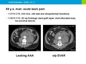 EVAR Endoleaks RAML 1 31 17 1 59