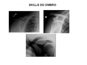 SKILLS DO OMBRO FRACTURAS DA CLAVCULA FRACTURAS DA