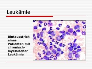 Leukmie Blutausstrich eines Patienten mit chronischmyeloischer Leukmie Leukmie