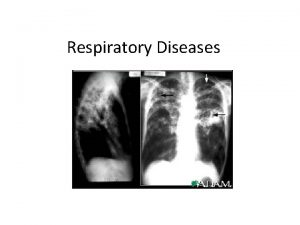 Respiratory Diseases Emphysema Emphysema Histology Asthma Asthma Asthma