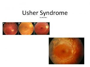 Usher Syndrome By Andy Beer What is Usher