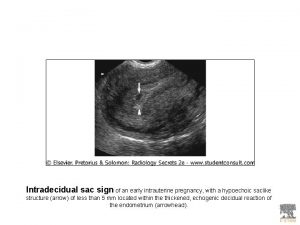 Intradecidual sac sign of an early intrauterine pregnancy