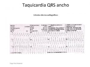 Taquicardia QRS ancho Criterios electrocardiogrficos Diego Fdez Redondo