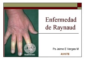 Enfermedad de Raynaud Ps Jaime E Vargas M