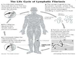 Lymphatic filariasis also known as elephantiasis is a