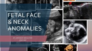 FETAL FACE NECK ANOMALIES BY AMANDA MEADOWS DMS