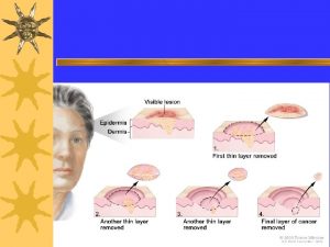 Radiation Electronic Brachytherapy e Bx Miniaturized Xrays to