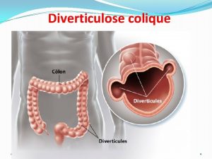 Diverticulose colique 20162017 DDF 1 1 Dfinition Le