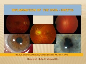 INFLAMMATION OF THE UVEA UVEITIS MUDr Karkanov Michala