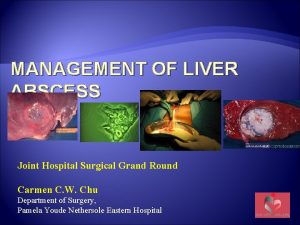 MANAGEMENT OF LIVER ABSCESS Joint Hospital Surgical Grand