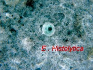 E Histolytica Pathogenesis pathology E Histolytica can effect