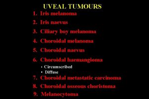 UVEAL TUMOURS 1 Iris melanoma 2 Iris naevus