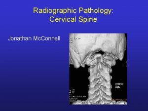Radiographic Pathology Cervical Spine Jonathan Mc Connell AP