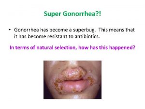 Super Gonorrhea Gonorrhea has become a superbug This