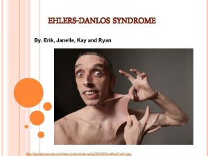 EHLERSDANLOS SYNDROME By Erik Janelle Kay and Ryan