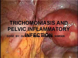 TRICHOMONIASIS AND PELVIC INFLAMMATORY DONE BY GURJOT IMAN