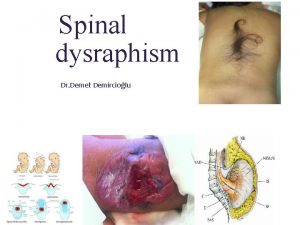 Spinal dysraphism Dr Demet Demirciolu Formation and separation Spinal dysraphism Dr Demet Demirciolu Formation and separation