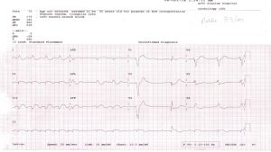 Alternating bundle branch block is diagnosed when conducted