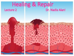 Healing Repair Lecture 2 Dr Nadia Alani Wound