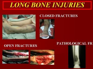 LONG BONE INJURIES CLOSED FRACTURES OPEN FRACTURES PATHOLOGICAL