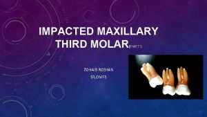 IMPACTED MAXILLARY THIRD MOLAR PART 1 ZOHAIB ROSHAN