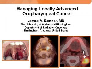 Managing Locally Advanced Oropharyngeal Cancer James A Bonner