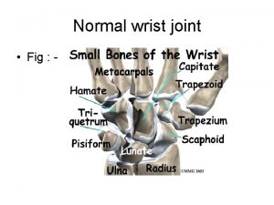 Normal wrist joint Fig Scaphoid fracture skaphea boat