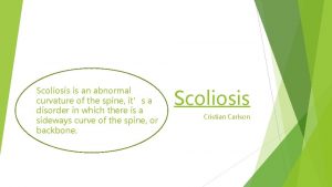 Scoliosis is an abnormal curvature of the spine