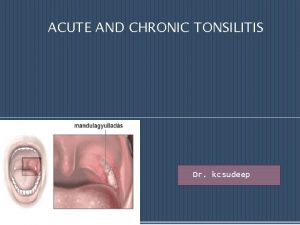 ACUTE AND CHRONIC TONSILITIS Dr kcsudeep ANATOMY p