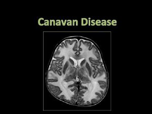 Canavan Disease Alternative Names Spongy degeneration of the