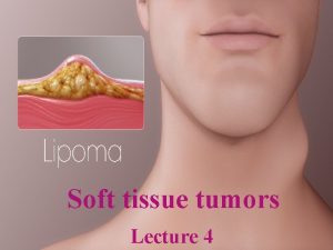 Soft tissue tumors Lecture 4 Soft tissue tumors