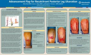 Advancement Flap for Recalcitrant Posterior Leg Ulceration Nisha