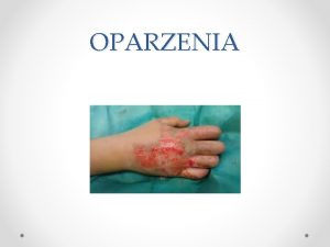 OPARZENIA Oparzenia definicja Uszkodzenie skry i w zalenoci