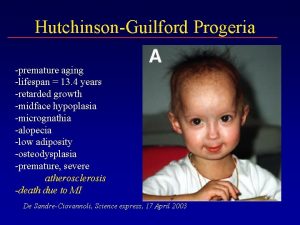 HutchinsonGuilford Progeria premature aging lifespan 13 4 years