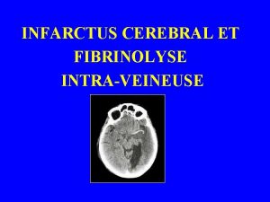 INFARCTUS CEREBRAL ET FIBRINOLYSE INTRAVEINEUSE HISTORIQUE ECASS 1