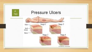 P 790 Pressure Ulcers Compare and contrast skin